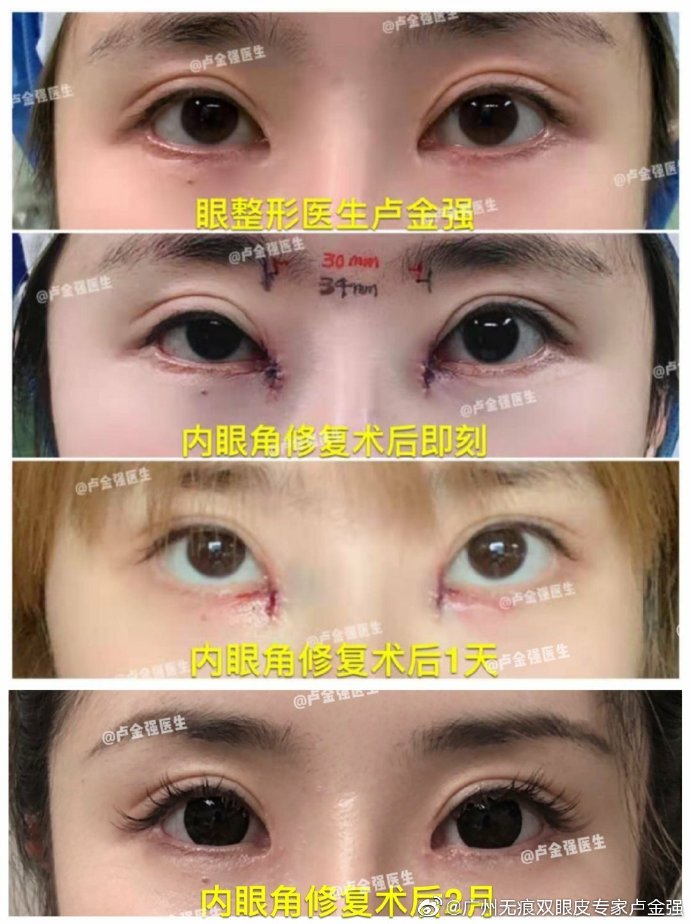 盧金強內眼角修復案例