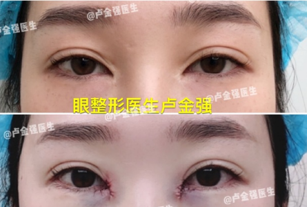 廣州盧金強內眼角修復多少錢