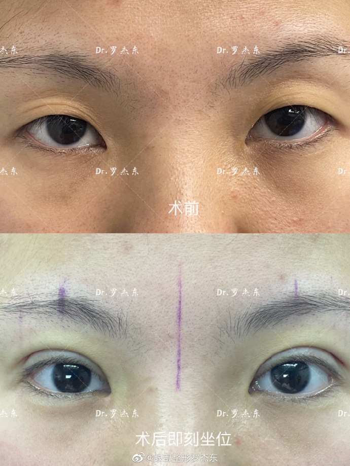 羅杰東眼整形案例
