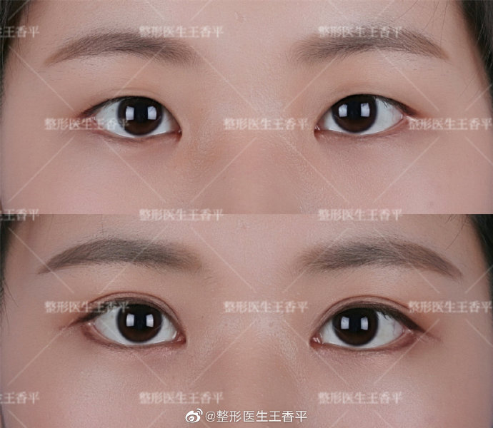 王香平雙眼皮案例