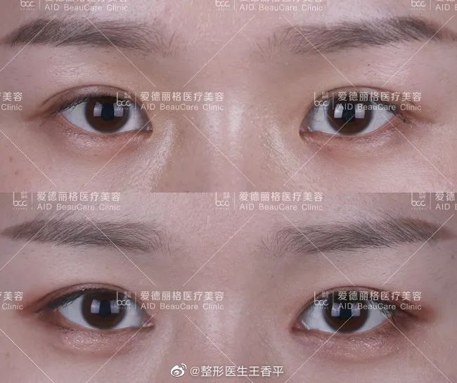 王香平雙眼皮修復案例