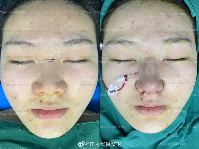田永華隆鼻案例