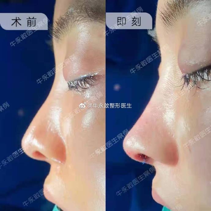 牛勇敢做鼻修復案例