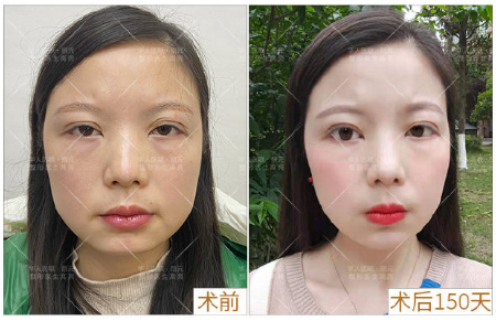 高亮雙眼皮案例