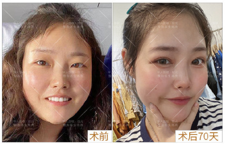 高亮雙眼皮案例