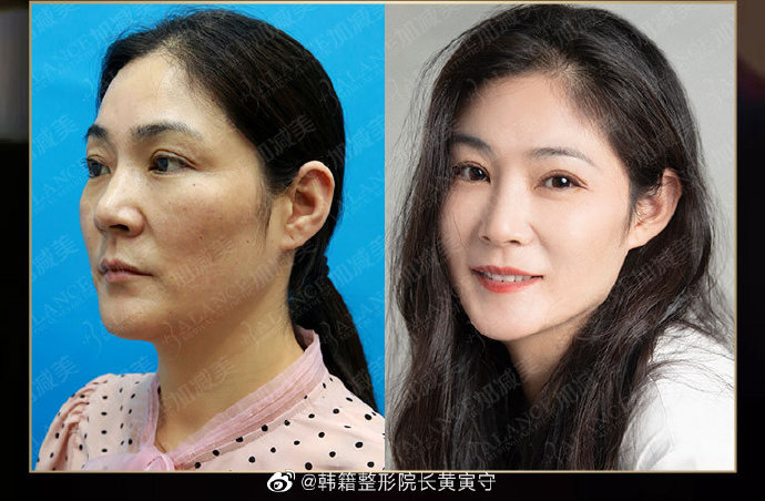 黃醫生拉皮案例