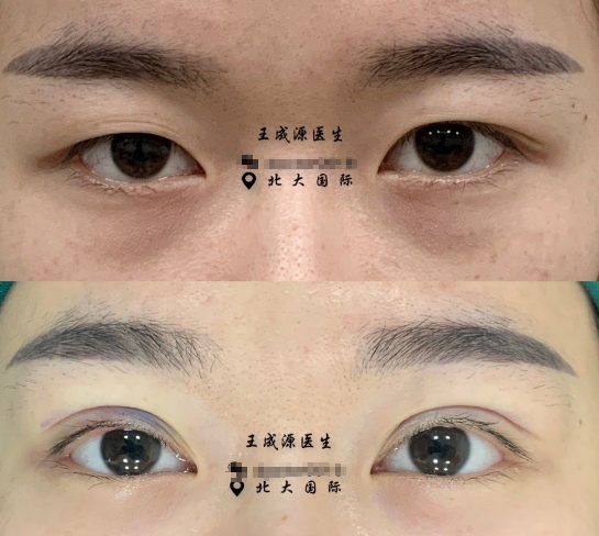 北大國際整形王成源雙眼皮修復技術(shù)怎么樣