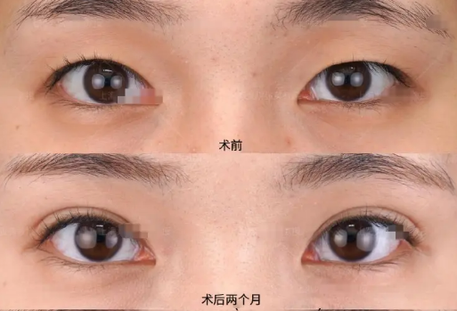 安醫(yī)大二附院朱邦中修復(fù)雙眼皮怎么樣