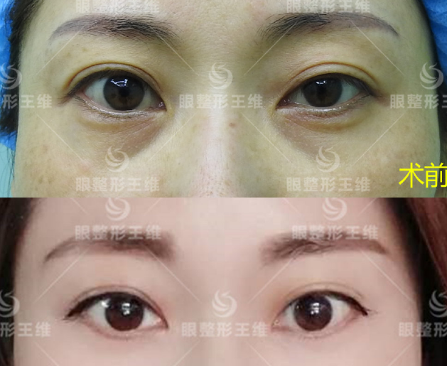 王維雙眼皮修復(fù)案例