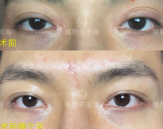 北京韓勛和王維誰修復雙眼皮厲害