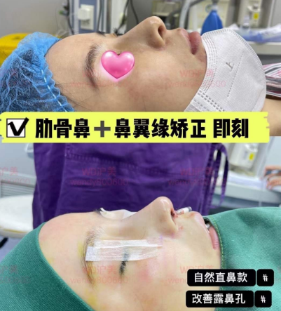 上海李章醫生做的鼻子怎么樣