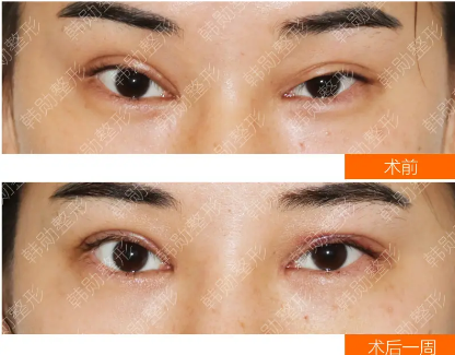 北京雙眼皮修復(fù)最牛的醫(yī)生是誰
