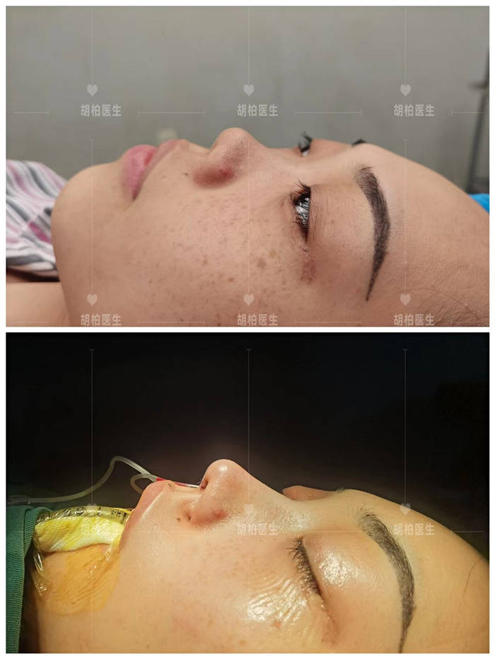 浙江胡柏醫生做鼻子怎么樣