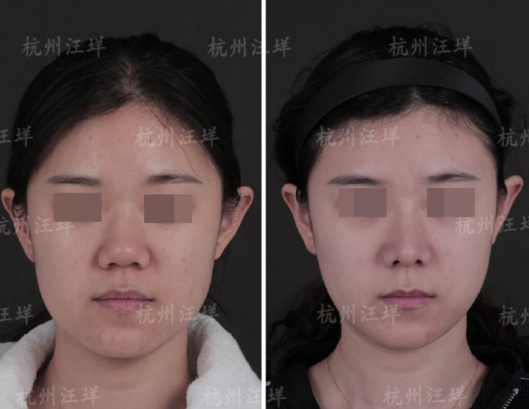 杭州汪垟做鼻修復(fù)技術(shù)好嗎