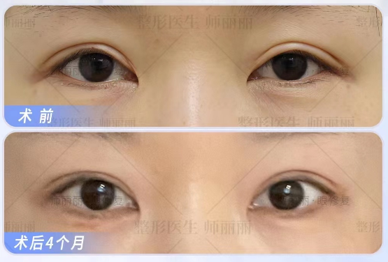 2023年北京雙眼皮修復(fù)最好的專家