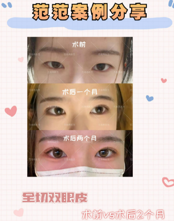 范海燕雙眼皮案例