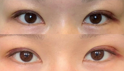 上海九院做雙眼皮哪個醫生比較好