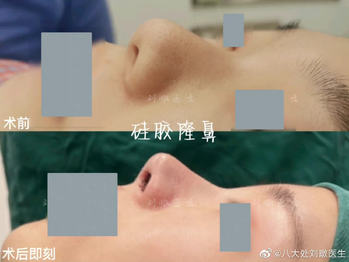 北京八大處劉暾做的鼻子怎么樣