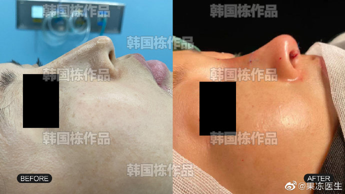 成都韓國棟鼻子做得怎么樣