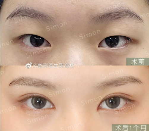 杭州陳海華做雙眼皮技術怎么樣？
