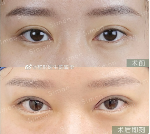 陳海華雙眼皮修復案例