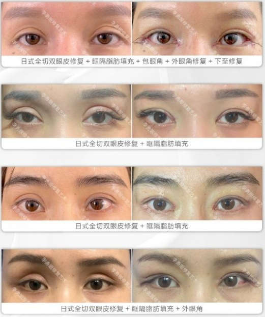 李勇做雙眼皮修復(fù)案例