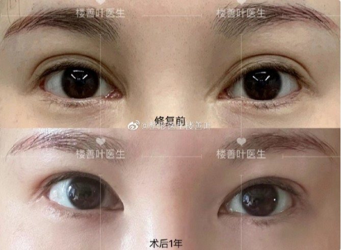 樓善葉包內眼角案例