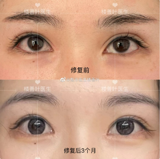 樓善葉包內眼角案例
