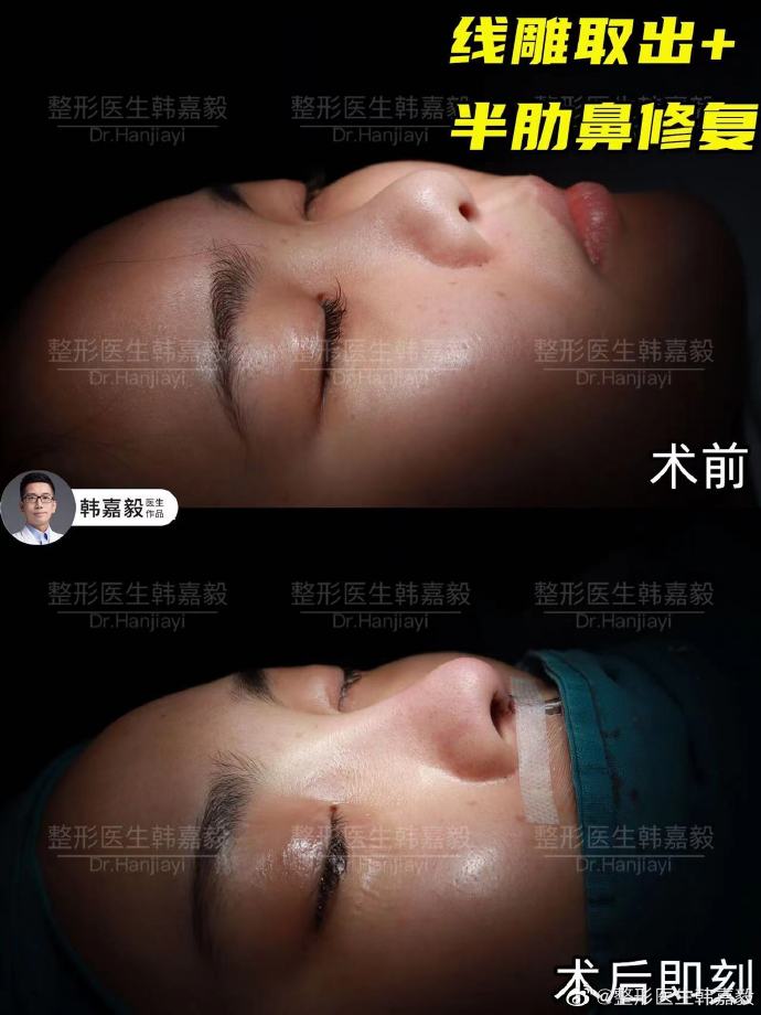 韓嘉毅鼻修復(fù)案例