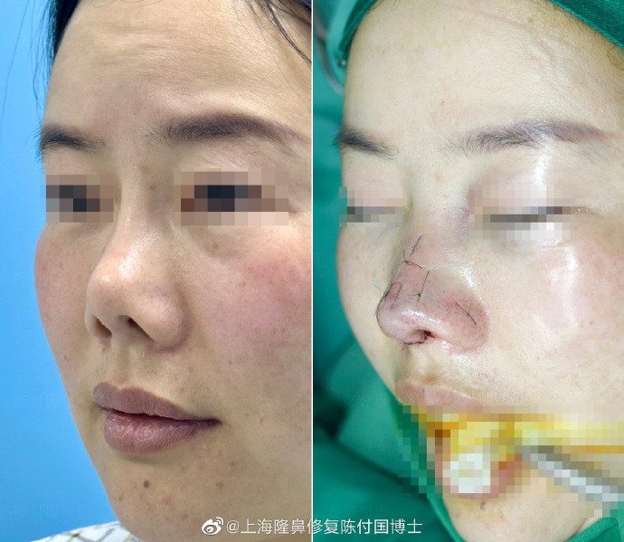 陳付國鼻修復案例