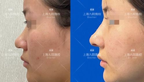 上海九院鼻修復(fù)哪個(gè)醫(yī)生好