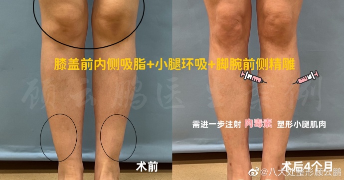 八大處哪個醫生做抽脂好