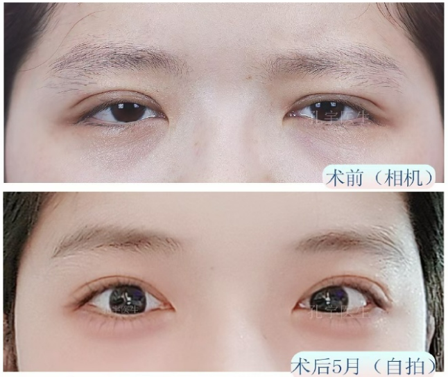孔宇雙眼皮修復案例