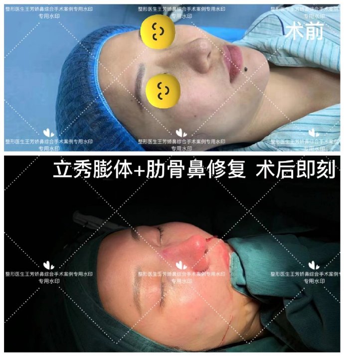 王芳嬌鼻修復(fù)案例