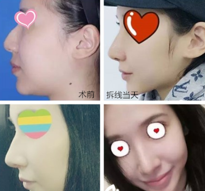 上海九院鼻修復(fù)李青峰和戴傳昌哪個(gè)好