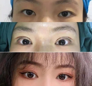 西京宋寶強做雙眼皮修復怎么樣