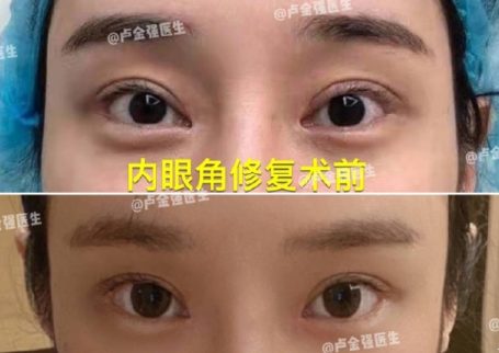 盧金強內(nèi)眼角修復案例