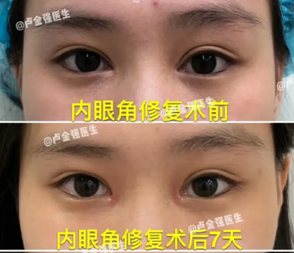 盧金強內(nèi)眼角修復案例