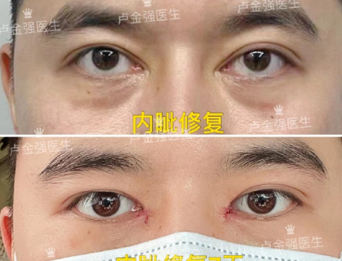 廣州盧金強(qiáng)做雙眼皮修復(fù)怎么樣