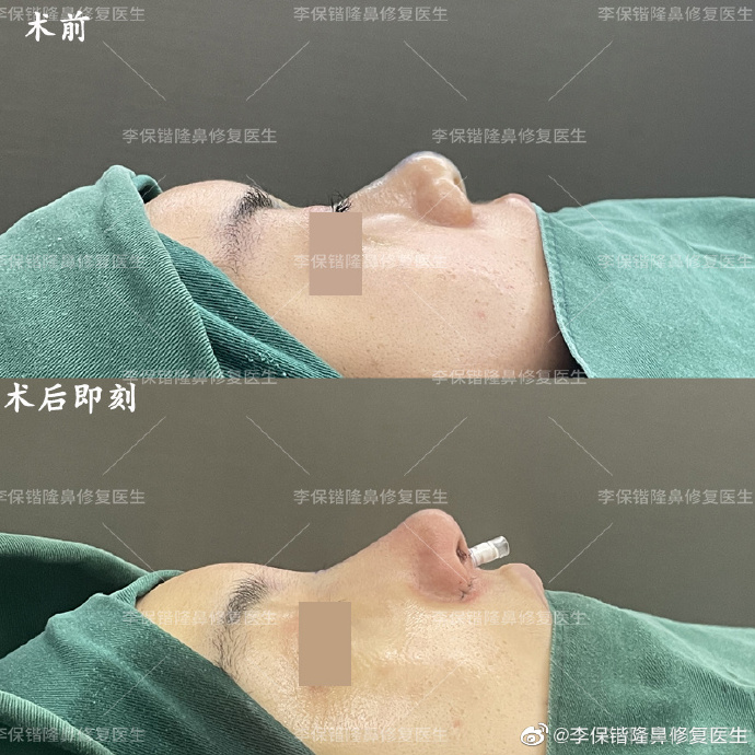 杭州隆鼻哪個醫生比較好