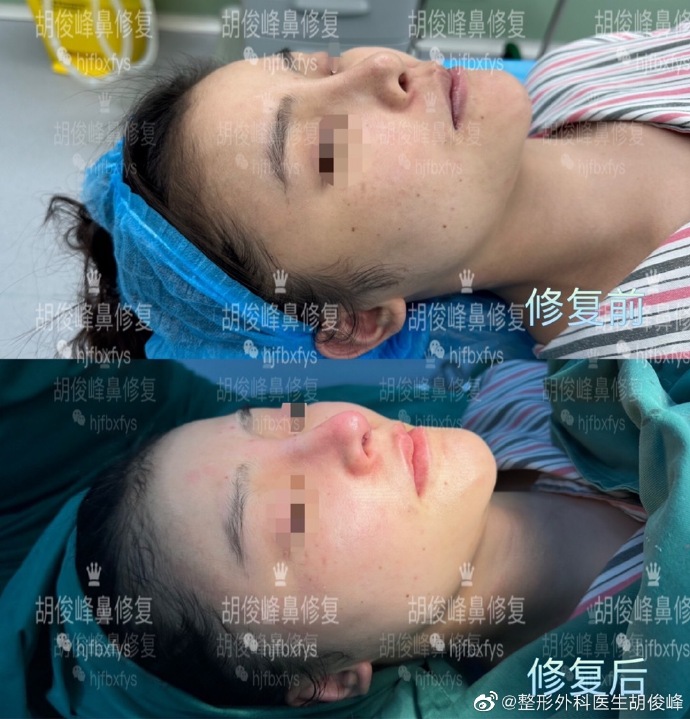 胡俊峰鼻修復案例