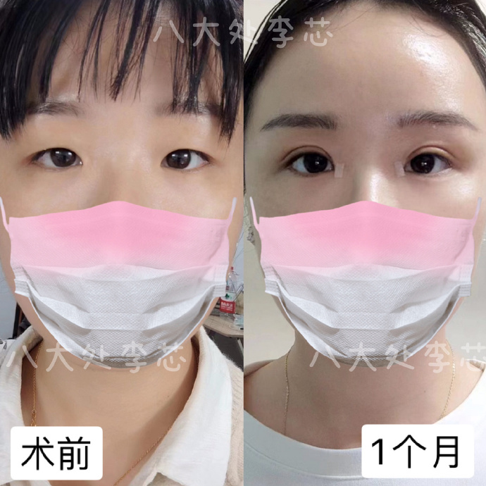 李芯雙眼皮案例