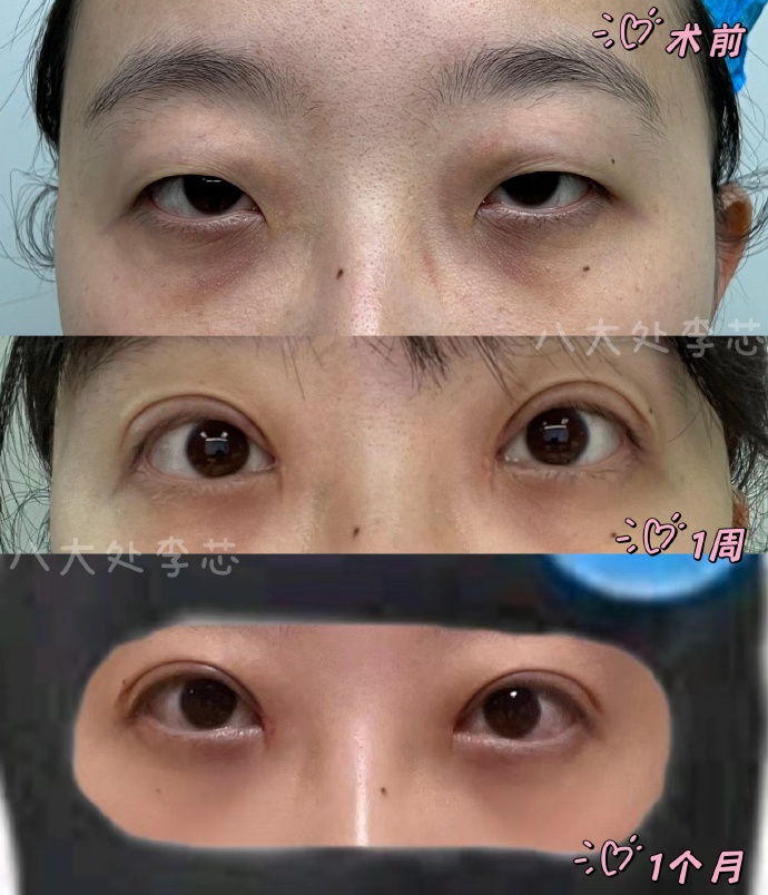 李芯雙眼皮案例