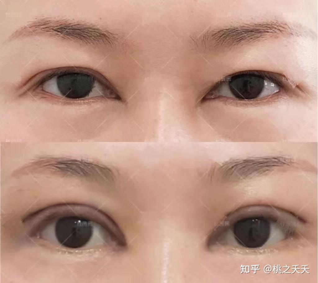 劉曉偉雙眼皮修復案例