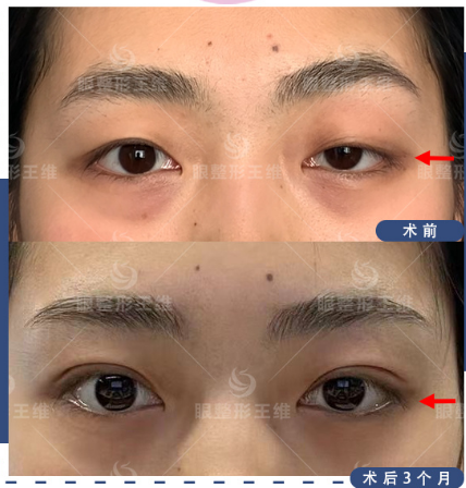 北京王維和常冬青哪個眼修復(fù)厲害