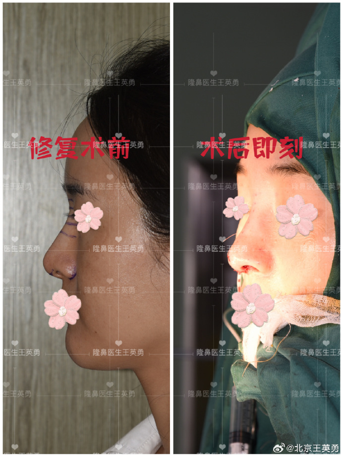 鼻修復(fù)王英勇和李長(zhǎng)富哪個(gè)醫(yī)生好