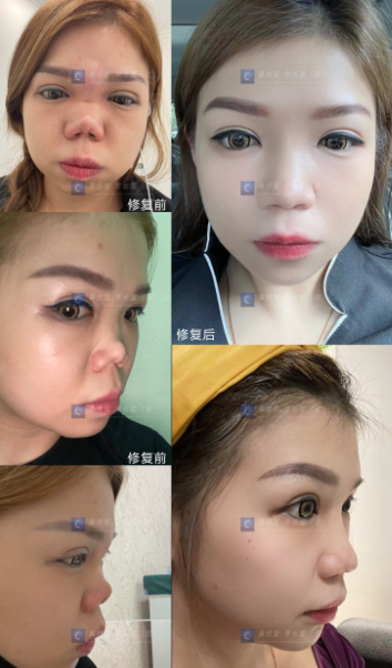 李長富鼻修復