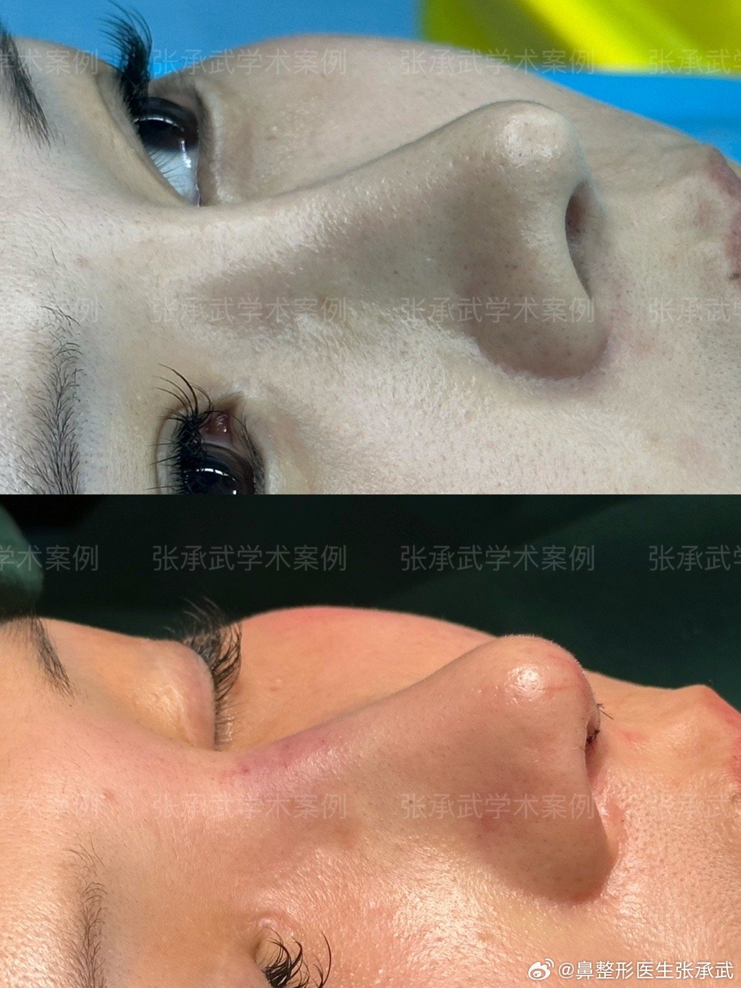 張承武做鼻子案例