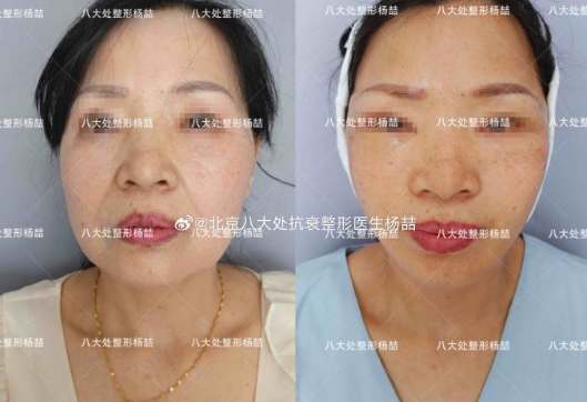 北京八大處拉皮醫(yī)生楊喆和趙延勇哪個(gè)好