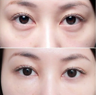 北京去眼袋比較有名的醫(yī)生是誰